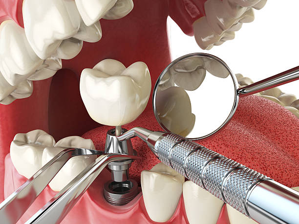 Best Emergency Root Canal Treatment in Drew, MS